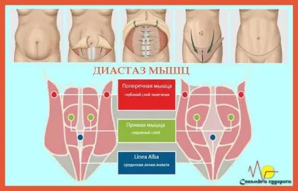 Спазм м'язів живота