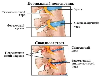 Спондилоартроз що це таке, які ступеня і як лікувати (фото, відео) (ступеня) Спондилоартроз що це таке, які ступеня і як лікувати (фото, відео)