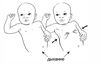 Стридор (стридорозне дихання) вроджений, у дітей, новонароджених (дітей) Стридор (стридорозне дихання) вроджений, у дітей, новонароджених