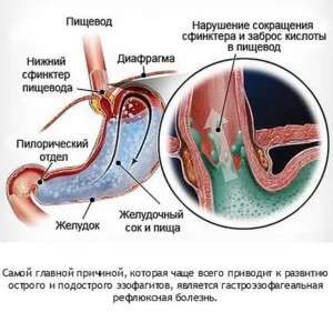 Схема лікування рефлюкс-езофагіту лікарськими препаратами (лікування) Схема лікування рефлюкс-езофагіту лікарськими препаратами