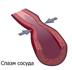 Типова форма інфаркту міокарда, головна ознака (головна ознака типового інфаркту міокарда) Типова форма інфаркту міокарда, головна ознака