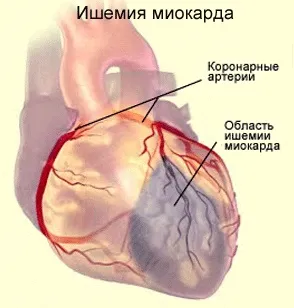 Типова форма інфаркту міокарда, головна ознака (міокарда) Типова форма інфаркту міокарда, головна ознака