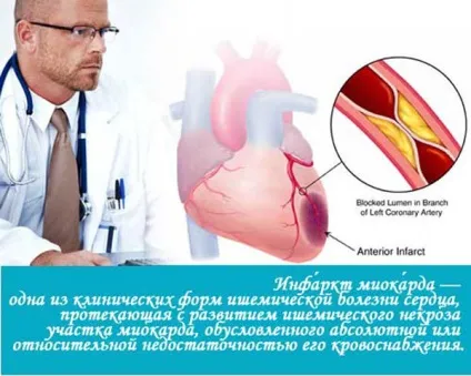 Типова форма інфаркту міокарда - що це таке, діагностика, періоди