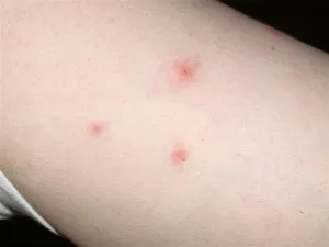 Цькування клопів в квартирі різними засобами (труїти клопів квартирі) Цькування клопів в квартирі різними засобами