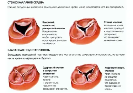 Трикуспідального клапан серця - що це таке (серця) Трикуспідального клапан серця - що це таке
