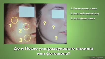 Ультразвукова чистка обличчя, або ваших кишень (чистка) Ультразвукова чистка обличчя, або ваших кишень