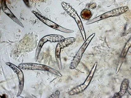 Вугрової железница фото demodex folliculorum, canis що це таке (вугровий) Вугрової железница фото demodex folliculorum, canis що це таке