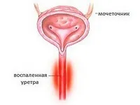 Уретропростатит що це, симптоми, лікування (лікування) Уретропростатит що це, симптоми, лікування