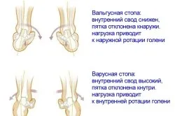 Вправи при варусной постановці стоп