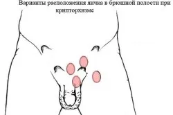 Узі яєчок у чоловіків, важливість проведення процедури (важливість) Узі яєчок у чоловіків, важливість проведення процедури