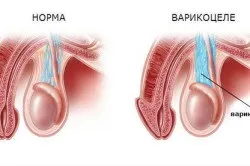 Узі яєчок у чоловіків, важливість проведення процедури (проведення) Узі яєчок у чоловіків, важливість проведення процедури