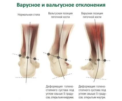 Варусна деформація стопи у дітей принципи лікування