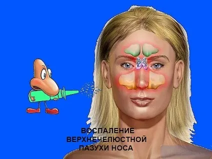Вилікувати гайморит симптоми захворювання, методи лікування (лікування) Вилікувати гайморит симптоми захворювання, методи лікування