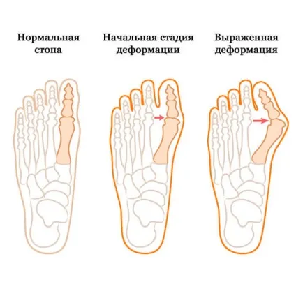 Вилікувати hallux valgus, кісточку, без операції можливо! (можливо) Вилікувати hallux valgus, кісточку, без операції можливо!