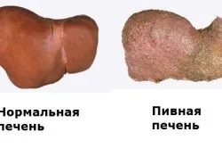 Вплив пива на печінку симптоми і лікування, профілактика (відео та фото) (пива) Вплив пива на печінку симптоми і лікування, профілактика (відео та фото)