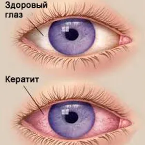 Вірусний кератит лікування і симптоми (лікування) Вірусний кератит лікування і симптоми