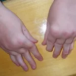 Хронічний ювенільний артрит лікування у дітей (хронічний) Хронічний ювенільний артрит лікування у дітей