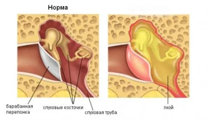 Хронічний мезотимпанит симптоми і лікування, що це таке (мезотимпанит) Хронічний мезотимпанит симптоми і лікування, що це таке