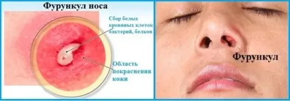 Гнійник в носі що робити і як позбутися (носі) Гнійник в носі що робити і як позбутися