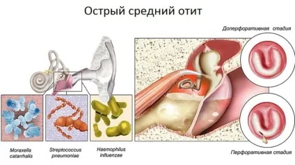 гнійний отит