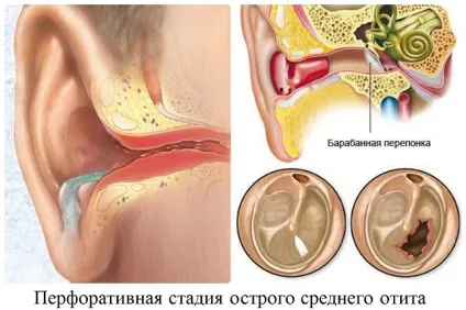 гнійний отит