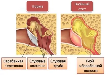 гнійний отит