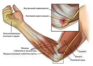 Защемлення нерва в ліктьовому суглобі симптоми і лікування (домашніх) Защемлення нерва в ліктьовому суглобі симптоми і лікування