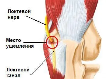 Защемлення ліктьового нерва лікування, симптоми (лікування) Защемлення ліктьового нерва лікування, симптоми