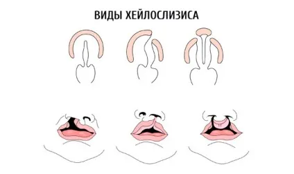 Заяча губа, компетентно про здоров'я на ilive (дефект) Заяча губа, компетентно про здоров'я на ilive