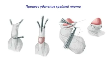 Загоєння після обрізання і можливі ускладнення (обрізання) Загоєння після обрізання і можливі ускладнення
