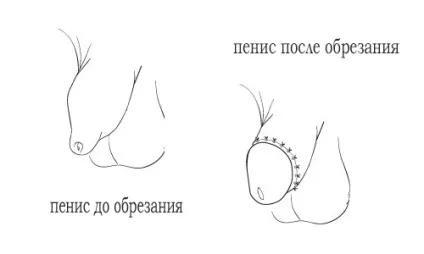 Загоєння після обрізання і можливі ускладнення (різного роду патологічних) Загоєння після обрізання і можливі ускладнення
