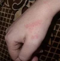 Сверблячка і почервоніння на руках - про що говорять ці симптоми, і як швидко позбутися від неприємних (симптоми) Сверблячка і почервоніння на руках - про що говорять ці симптоми, і як швидко позбутися від неприємних