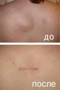 Жировики на обличчі
