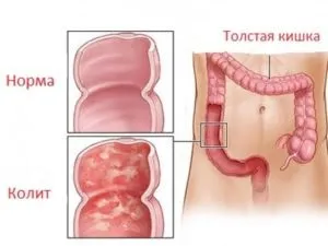Рідкий стілець у дорослого тривалий час, причини (дорослого) Рідкий стілець у дорослого тривалий час, причини