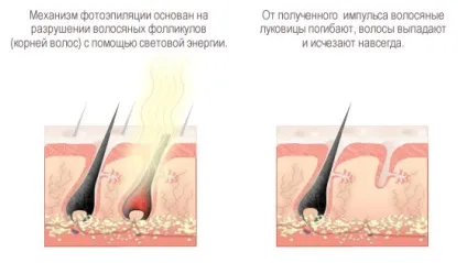 Як підготуватися до фотоепіляції поради та рекомендації (підготуватися) Як підготуватися до фотоепіляції поради та рекомендації