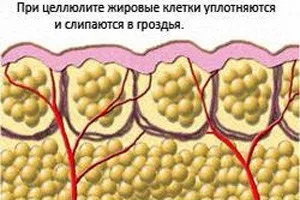 Як перевірити чи є целюліт