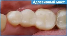 адгезивний міст