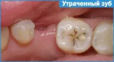 адгезивний міст