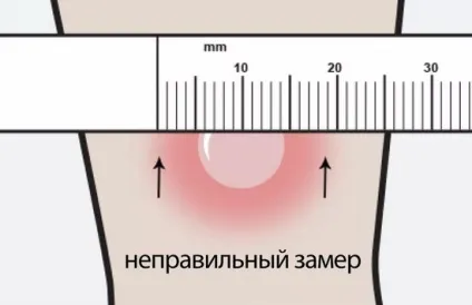 Алергія на манту у дитини симптоми алергічної реакції після проби манту (реакції) Алергія на манту у дитини симптоми алергічної реакції після проби манту