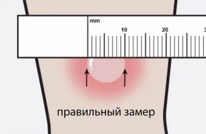 Алергія на манту у дитини симптоми алергічної реакції після проби манту (алергічної) Алергія на манту у дитини симптоми алергічної реакції після проби манту