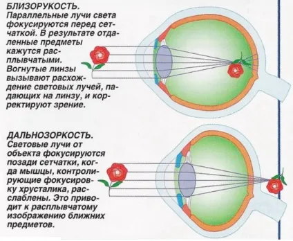 Короткозорість у дітей шкільного віку лікування