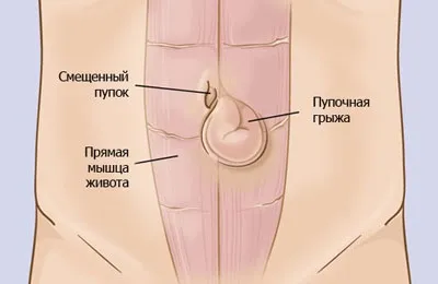 Болі при грижі пупка причини і методи лікування (болю) Болі при грижі пупка причини і методи лікування