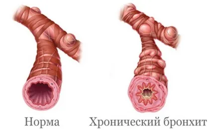 Бронхіт і пневмонія відмінності (бронхіт) Бронхіт і пневмонія відмінності