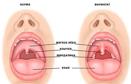 Біль в горлі без температури і нежиті, кашель і першіння причини (першіння і біль в горлі без температури) Біль в горлі без температури і нежиті, кашель і першіння причини
