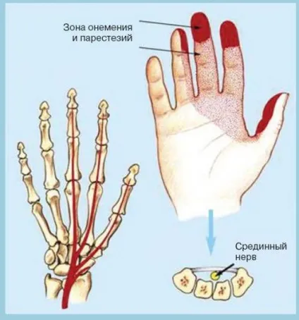 Біль у передпліччя остеоартроз, артрит або перенапруження