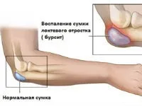 Чим і як лікувати бурсит ліктьового суглоба (мазі, народні засоби тощо (лікувати) Чим і як лікувати бурсит ліктьового суглоба (мазі, народні засоби і ін