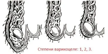 Чим небезпечне варикоцеле у чоловіків (чоловіків) Чим небезпечне варикоцеле у чоловіків