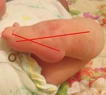 Що таке клишоногість і види клишоногості (вроджена і придбана) у дітей (клишоногість у новонароджених) Що таке клишоногість і види клишоногості (вроджена і придбана) у дітей