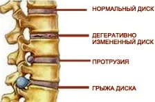 Що таке тейпінг терапія