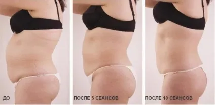 Що таке мезотерапія, її переваги і недоліки (мезотерапія) Що таке мезотерапія, її переваги і недоліки